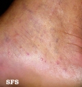 pustulosis palmaris et plantaris