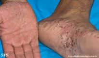 pustulosis palmaris et plantaris