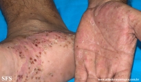 pustulosis palmaris et plantaris