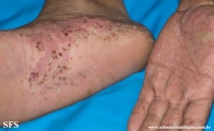 pustulosis palmaris et plantaris
