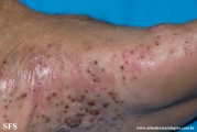 pustulosis palmaris et plantaris