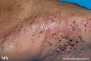 pustulosis palmaris et plantaris