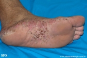 pustulosis palmaris et plantaris