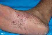 pustulosis palmaris et plantaris