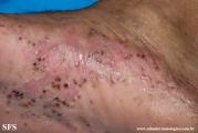 pustulosis palmaris et plantaris