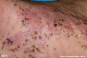 pustulosis palmaris et plantaris