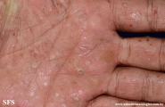 pustulosis palmaris et plantaris