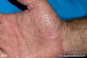 pustulosis palmaris et plantaris