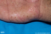 pustulosis palmaris et plantaris