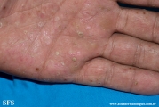 pustulosis palmaris et plantaris