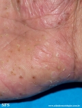 pustulosis palmaris et plantaris