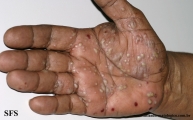pustulosis palmaris et plantaris