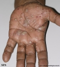 pustulosis palmaris et plantaris