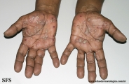 pustulosis palmaris et plantaris