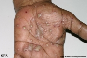 pustulosis palmaris et plantaris