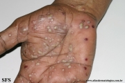 pustulosis palmaris et plantaris