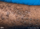 lichen amyloidosus