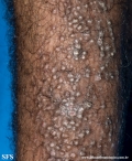 lichen amyloidosus