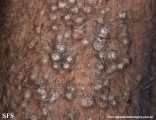 lichen amyloidosus