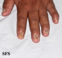 psoriasis- nail psoriasis