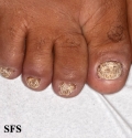 psoriasis- nail psoriasis
