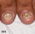 psoriasis- nail psoriasis
