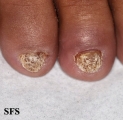 psoriasis- nail psoriasis
