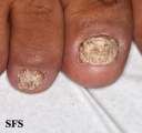 psoriasis- nail psoriasis