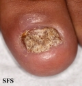 psoriasis- nail psoriasis