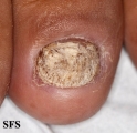 psoriasis- nail psoriasis