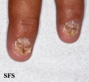 psoriasis- nail psoriasis