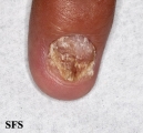 psoriasis- nail psoriasis