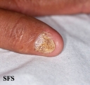 psoriasis- nail psoriasis
