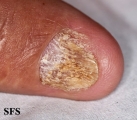 psoriasis- nail psoriasis