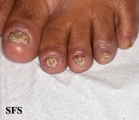 psoriasis- nail psoriasis