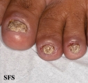 psoriasis- nail psoriasis