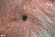 melanoacanthoma_and_keratosis_solar