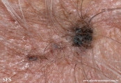 melanoacanthoma_and_keratosis_solar