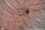 melanoacanthoma_and_keratosis_solar