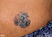 bowen's disease