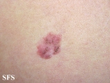 bowen's disease