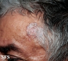 bowen's disease