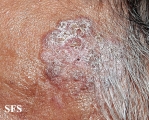 bowen's disease