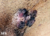 bowen's disease