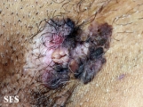 bowen's disease