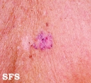 bowen's disease