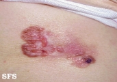 bowen's disease