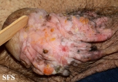 bowen's disease