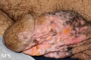 bowen's disease