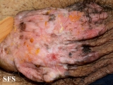 bowen's disease